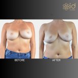 Before and after breast implant removal results at ID Clinic Bangkok, natural breast contour