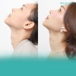 Before and after tracheal shave results at Wansiri Hospital – smoother neck contour visible