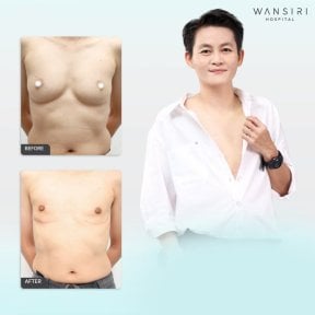 Before and after top surgery results at Wansiri Hospital, chest masculinization procedure