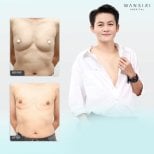 Before and after top surgery results at Wansiri Hospital, chest masculinization procedure