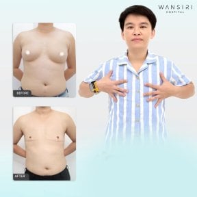Before and after top surgery results at Wansiri Hospital, chest masculinization procedure