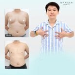 Before and after top surgery results at Wansiri Hospital, chest masculinization procedure