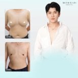 Before and after top surgery results at Wansiri Hospital – masculinized chest transformation
