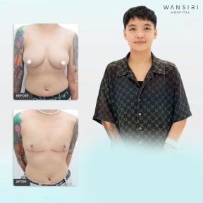 Before and after top surgery results at Wansiri Hospital, chest masculinization procedure