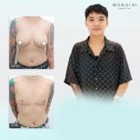 Before and after top surgery results at Wansiri Hospital, chest masculinization procedure