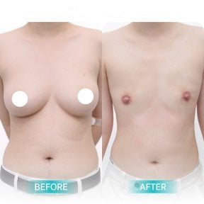 Before and after top surgery results at Wansiri Hospital, chest masculinization procedure