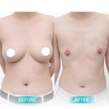 Before and after top surgery results at Wansiri Hospital, chest masculinization procedure