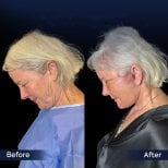 Before and after neck lift results at Dr. Safa Manav Clinic, visible neck tightening effect