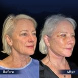 Before and after neck lift results at Dr. Safa Manav Clinic, visible neck and jawline tightening