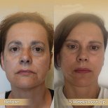 Vorher-nachher-Ergebnis Halsstraffung bei Dr. Safa Manav Clinic, sichtbare Konturverbesserung