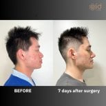 نتيجة تجميل الأنف قبل وبعد في ID Clinic Bangkok، تحسين شكل الأنف بعد 7 أيام