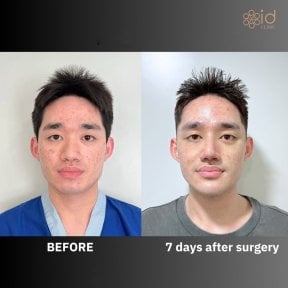 نتائج عملية تجميل الأنف قبل وبعد في ID Clinic Bangkok، تغيير واضح للأنف بعد 7 أيام