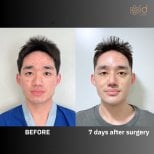 نتائج عملية تجميل الأنف قبل وبعد في ID Clinic Bangkok، تغيير واضح للأنف بعد 7 أيام