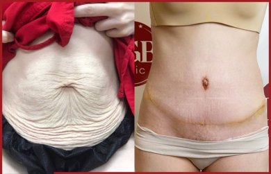Before and after tummy tuck and liposuction results at DGB Clinic – improved abdominal contour