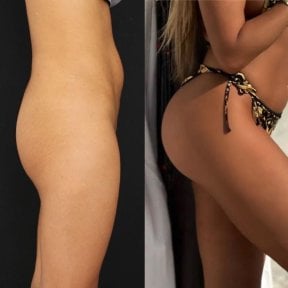 До и после ягодичных имплантов в клинике Dr. Safa Manav, улучшенные формы и объем