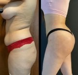 До и после ягодичных имплантов в клинике Dr. Safa Manav, улучшенный контур тела