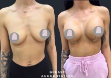 Before and after breast lift with round implants at Dr. MED – visible augmentation results