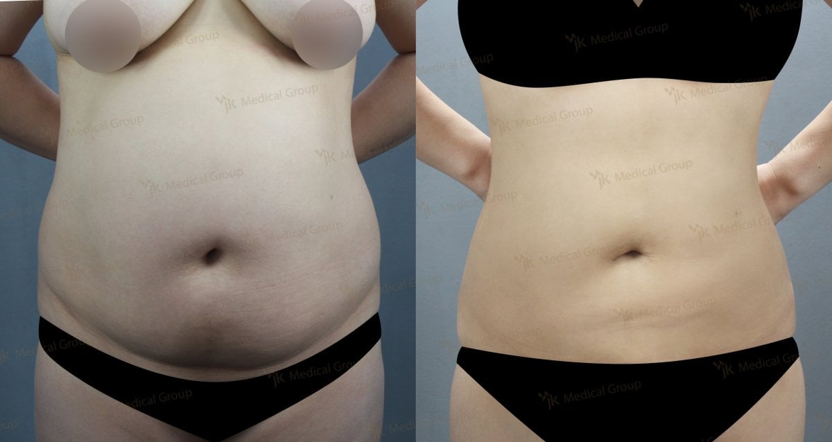 Resultados de liposucción antes y después en JK Plastic Surgery Center, abdomen definido