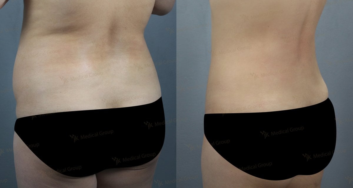 Resultados de liposucción antes y después en JK Plastic Surgery Center, contorno de cintura mejorado