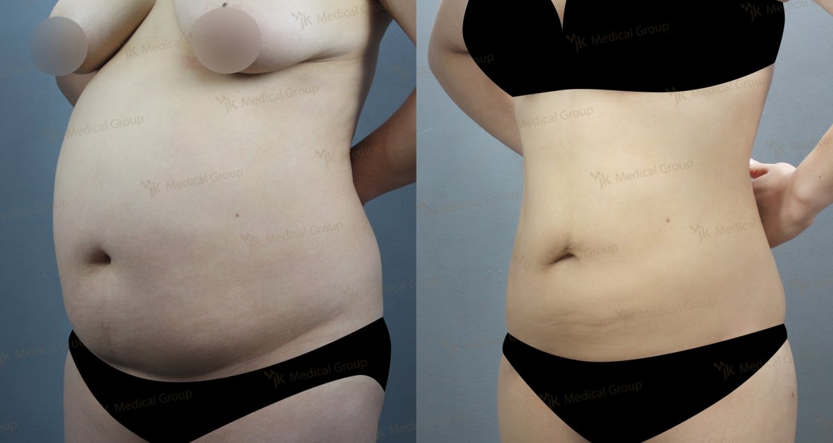 Resultados de liposucción antes y después en JK Plastic Surgery Center, contorno abdominal visible