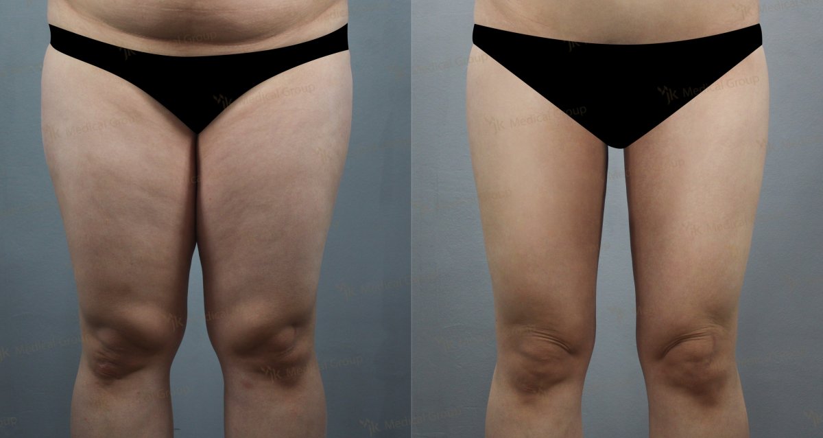 Resultados de liposucción antes y después en JK Plastic Surgery Center, mejora de muslos