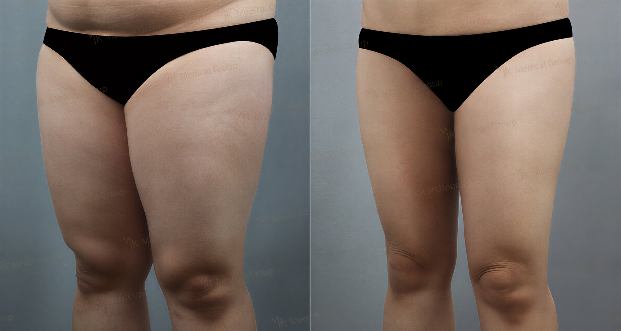 نتائج شفط الدهون قبل وبعد في JK Plastic Surgery Center، تحسين مظهر الفخذين