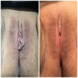 نتائج قبل وبعد عملية تجميل الشفرين في عيادة Assoc. Prof. Dr. Esra Özbaşlı OBGYN & Genital Aesthetics