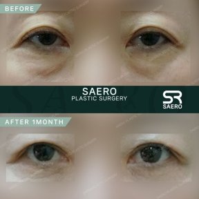 Vorher-nachher-Ergebnis Oberlidstraffung bei SAERO Plastic Surgery, 1 Monat