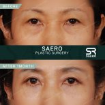 Vorher-nachher-Ergebnis Oberlidstraffung bei SAERO Plastic Surgery, verbesserte Augenpartie