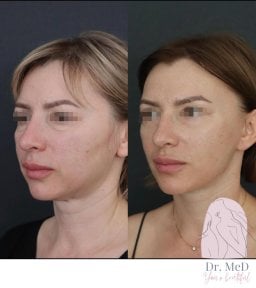 Resultado de rinoplastia antes y después en Dr. MED, remodelación nasal y perfil facial