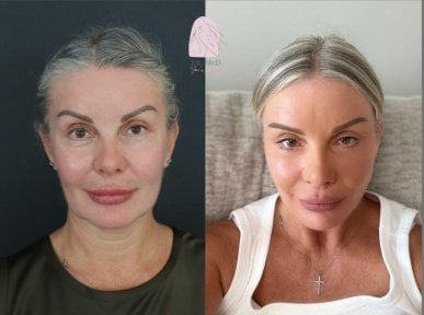 Resultados de rinoplastia antes y después en Dr. MED, remodelación nasal natural