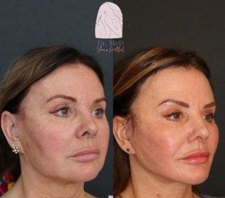 Resultados de lifting facial antes y después en Dr. MED, rejuvenecimiento visible de la piel