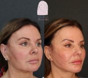Resultados de lifting facial antes y después en Dr. MED, rejuvenecimiento visible de la piel