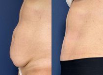 Vorher-nachher-Liposuktionsergebnis im Private Yüzyıl Hospital, verbesserte Bauchkontur