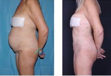 Liposuktion Vorher-Nachher-Ergebnis bei Private Yüzyıl Hospital, sichtbare Bauchkontur