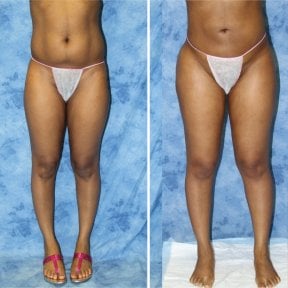 Vorher-nachher-Liposuktionsergebnis bei Private Yüzyıl Hospital, schlankere Oberschenkel und Bauch