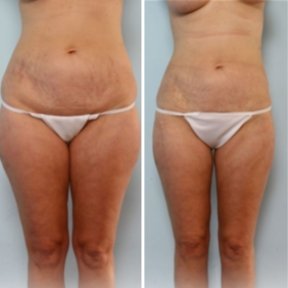 Vorher-nachher-Liposuktionsergebnis bei Private Yüzyıl Hospital, verbesserte Körperkontur