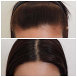 Результати пересадки волосся до і після в Department of Hair, Aesthetics & Surgery @ Navamin 9 Hospital
