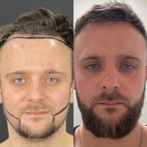 Before and after beard transplant results at Adem and Havva Medical Center, fuller beard achieved