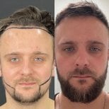 Before and after beard transplant results at Adem and Havva Medical Center, fuller beard achieved