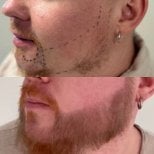 Before and after beard transplant results at Adem and Havva Medical Center, fuller beard achieved