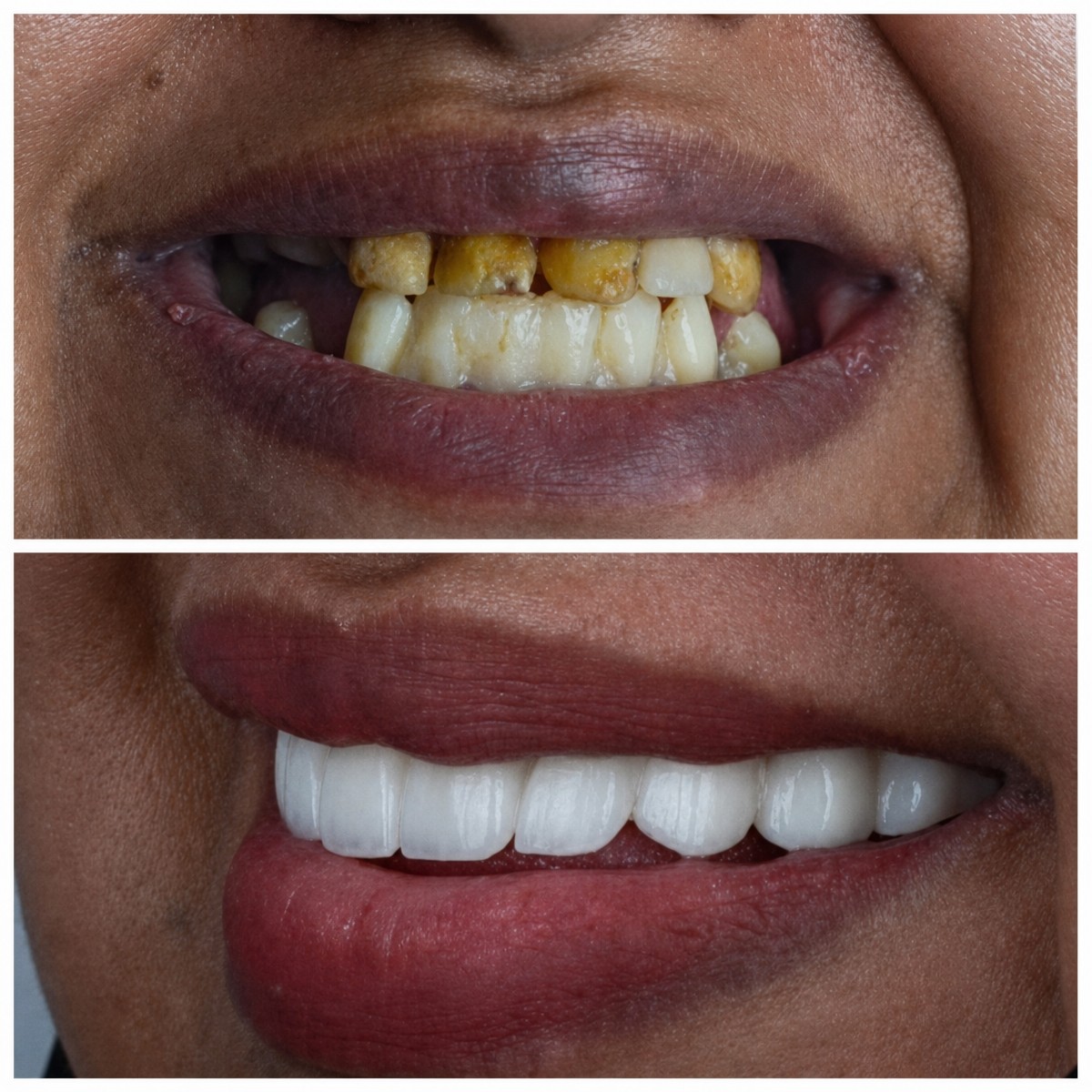 Resultados antes y después de implantes dentales en Omara Dental Centers – sonrisa restaurada