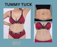 نتائج شد البطن قبل وبعد في ID Clinic Bangkok – تحسين واضح لشكل البطن