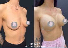 Before and after breast lift results at Dr. MED – improved breast shape and contour