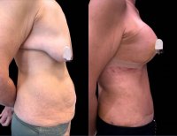 Before and after breast lift results at Dr. MED – improved breast contour and firmness