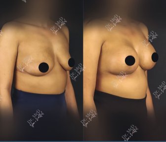 Before and after breast lift results at Dr. MED clinic, improved breast shape and contour