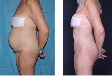 Vorher-nachher-Ergebnis der Bauchliposuktion in der Private Yüzyıl Hospital, Körperkontur