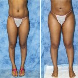 Vorher-nachher-Ergebnis der Bauchliposuktion in der Private Yüzyıl Hospital, Körperkontur