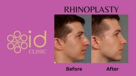 Dr.  тарапынан Ринопластика (мұрын пластикасы) бұрын және кейін фотосуреттері