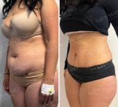 Before and after Vaser liposuction results at Dr. Safa Manav Clinic, improved abdominal contour
